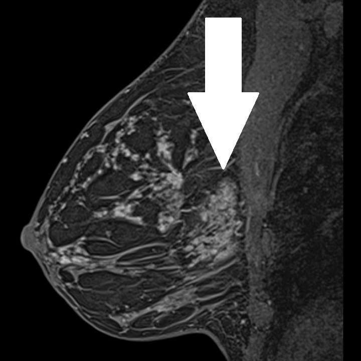 Дольки молочной железы фото. Магнито-резонансная томография молочной железы. Мрт молочной железы. Мрт молочной железы с контрастированием.