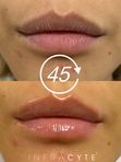 L.I.T. (Lip Infusion Therapy)