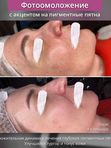 Фотоомоложение, эффект “фотошопа” для вашей кожи (IPL-терапия). Лицо без лба
