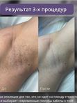 Александритовый лазер - подмышки
