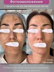 Фотоомоложение, эффект “фотошопа” для вашей кожи (IPL-терапия). Лицо полностью