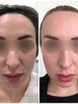 Безоперационный лифтинг FACE UP