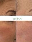 ФОТОДИНАМИЧЕСКАЯ ТЕРАПИЯ HELEO4