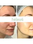 ФОТОДИНАМИЧЕСКАЯ ТЕРАПИЯ HELEO4