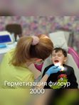 Герметизация фиссур