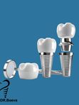Внутрикостная дентальная имплантация / Dentium (Implantium, Superline, Slimline)
