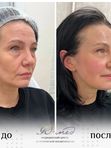 Векторное армирование лица и шеи
