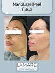 Лазерный пилинг кожи NanoLaserPeel Лицо
