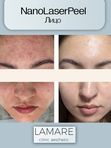 Лазерный пилинг кожи NanoLaserPeel Лицо