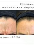 Ботокс, Ксеомин, Диспорт