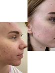 Фракционная шлифовка на CO2-лазере