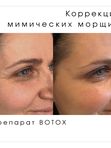 Ботокс, Ксеомин, Диспорт