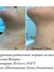Контурная пластика филлерами на основе гиалуроновой кислоты
