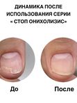 Бальзам регенерирующий для ногтей Стоп онихолизис