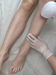 лазерная эпиляция голень/бедра
