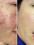 IPL  (Фототерапия) на аппарате Estetica 3.0