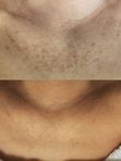 IPL  (Фототерапия) на аппарате Estetica 3.0