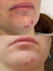 Лечение купероза, розацеа, акне,  омоложение