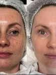 Фотоомоложение на аппарате Estetica 3.0