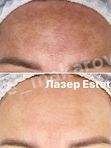 IPL  (Фототерапия) на аппарате Estetica 3.0