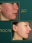 STOP акне лицо полностью