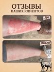 Мыло ММ • псориаз • дерматит • экзема