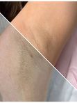 Лазерная эпиляция подмышечных впадин