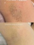 Лазерная эпиляция подмышечных впадин