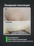 Лазерная эпиляция комплекс МИНИ