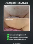 Лазерная эпиляция бикини