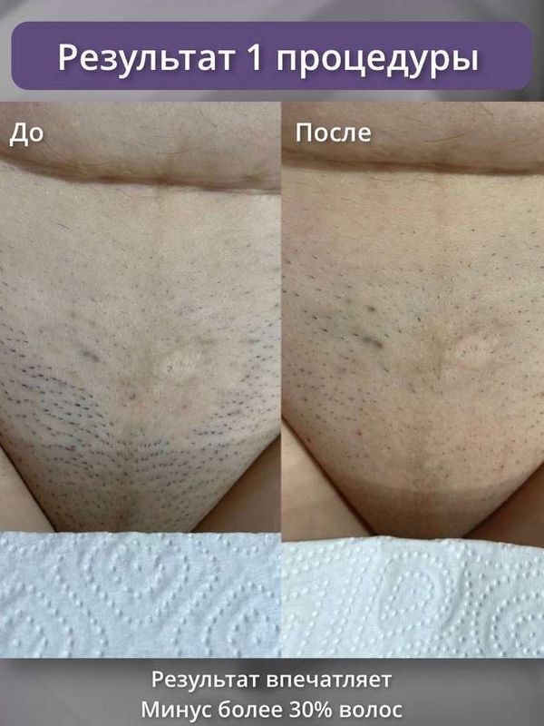 Диодный лазер ( голени и глубокое бикини )