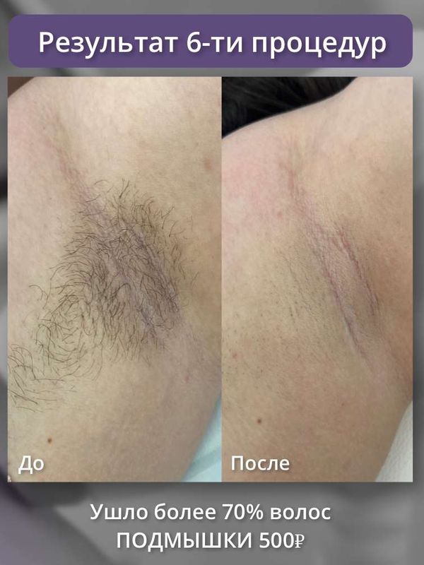 Диодный лазер - подмышки