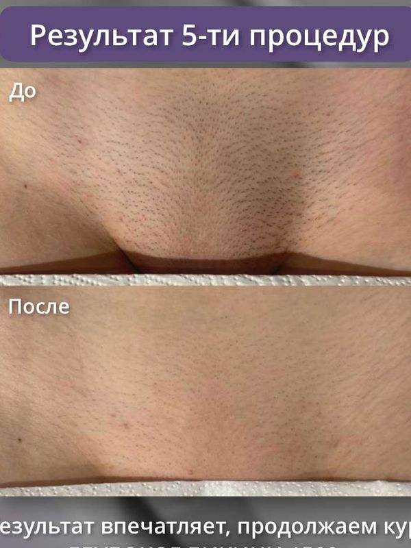 Диодный лазер ( бикини + подмышки + голени )