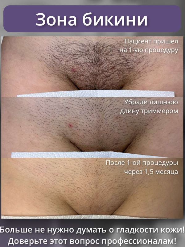 Александритовый лазер - бикини классика