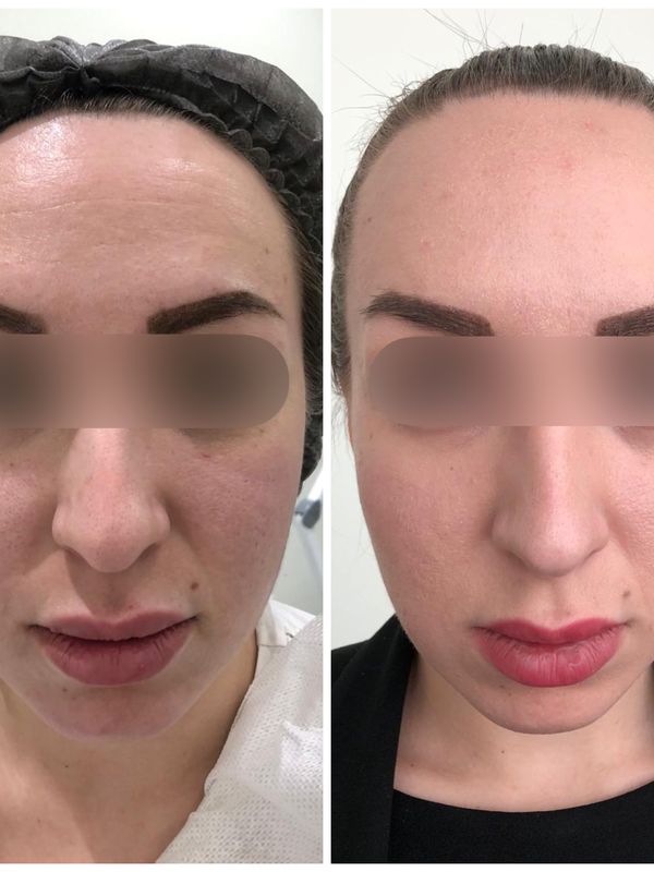 Безоперационный лифтинг FACE UP