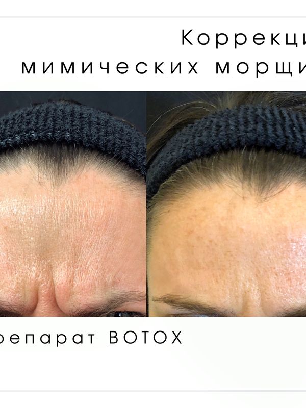 Ботокс, Ксеомин, Диспорт