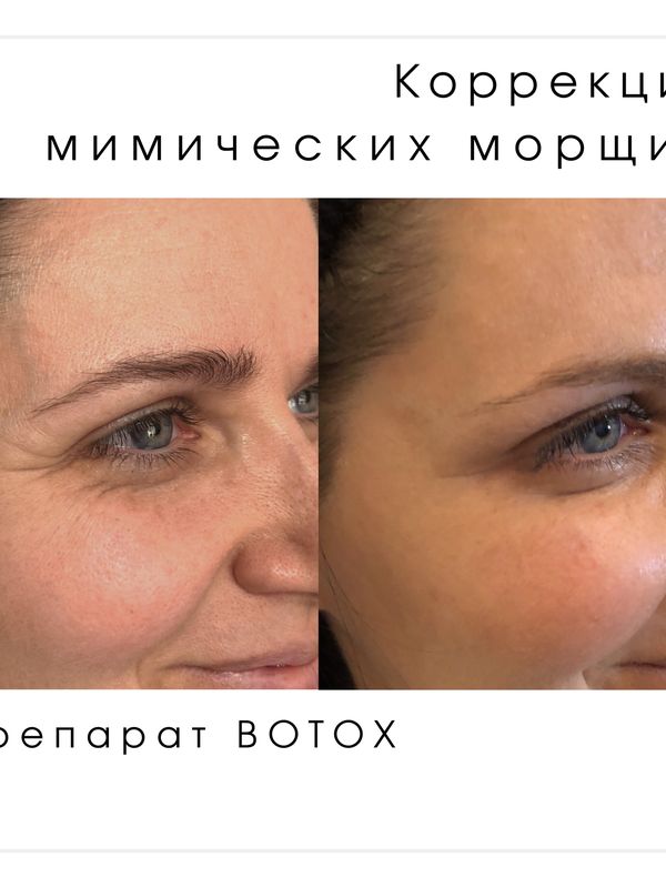 Ботокс, Ксеомин, Диспорт