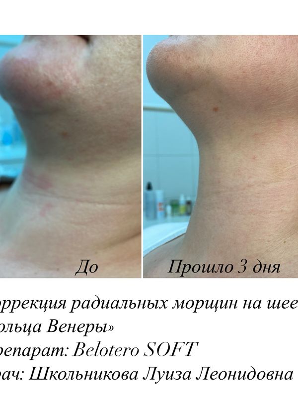 Контурная пластика филлерами на основе гиалуроновой кислоты