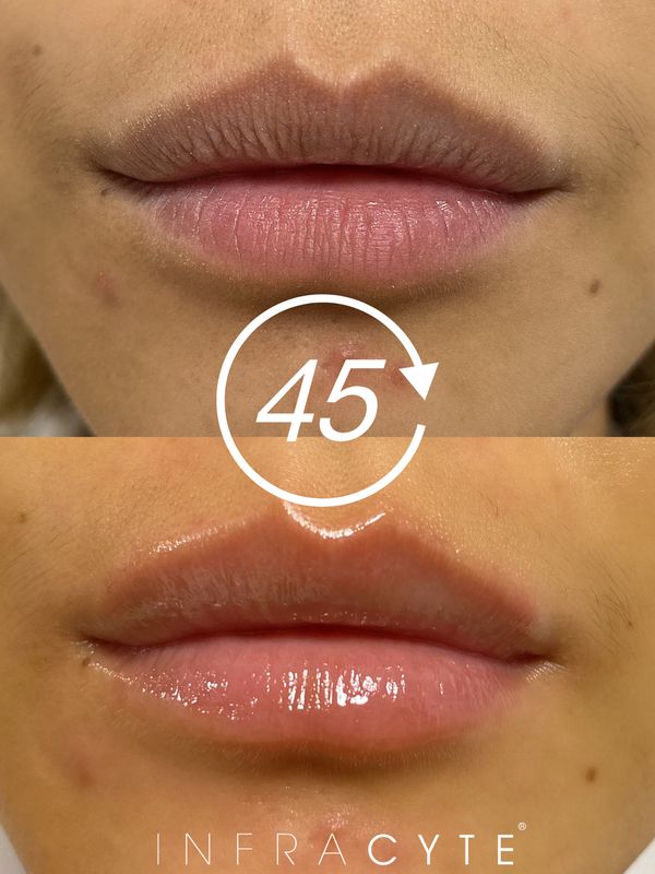 L.I.T. (Lip Infusion Therapy)