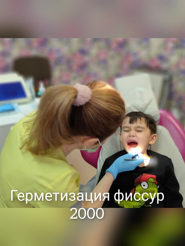 Герметизация фиссур
