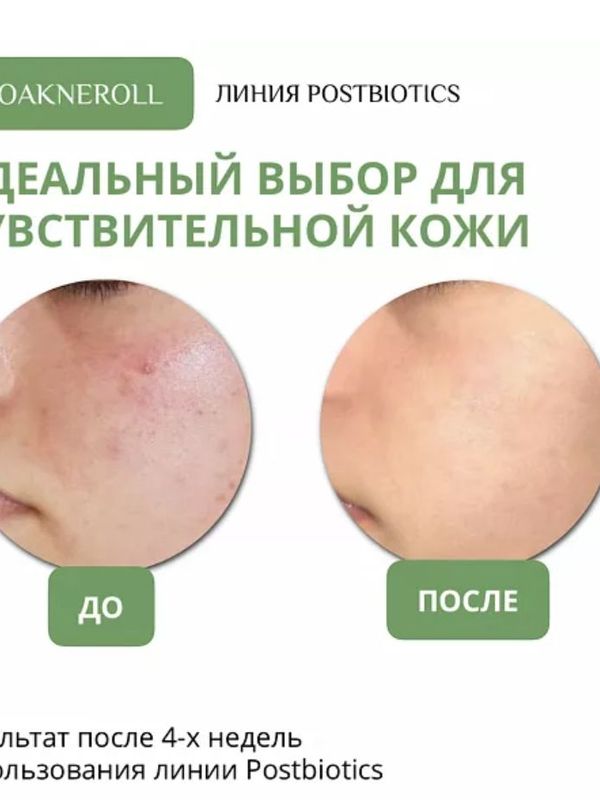 Тоник для лица "Bioakneroll Postbiotics" ДЛЯ ЧУВСТВИТЕЛЬНОЙ КОЖИ