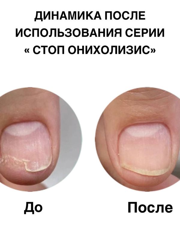 Бальзам регенерирующий для ногтей Стоп онихолизис