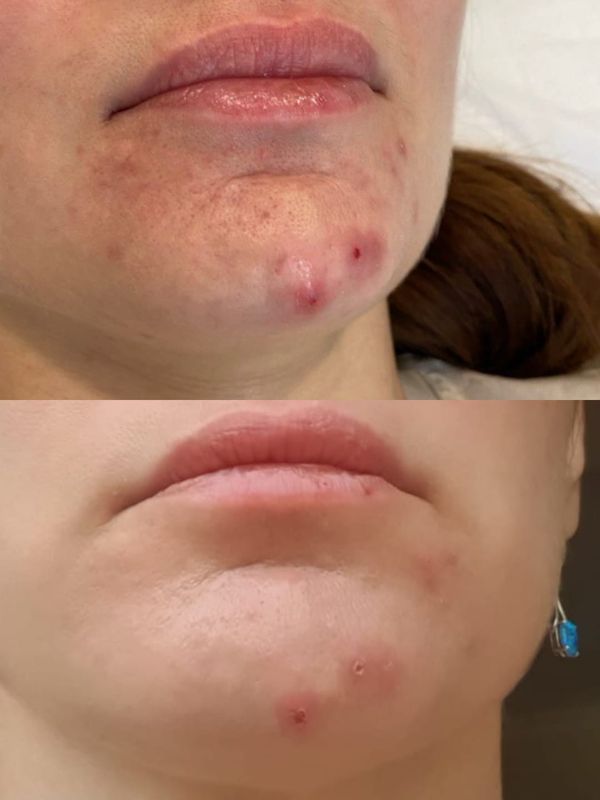 Лечение купероза, розацеа, акне,  омоложение