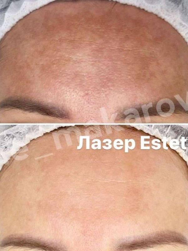 IPL  (Фототерапия) на аппарате Estetica 3.0