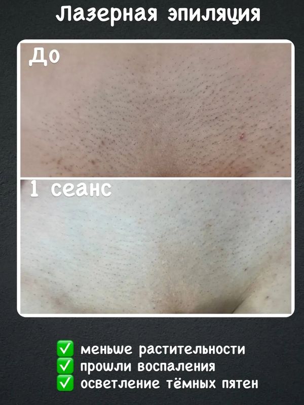 Лазерная эпиляция бикини