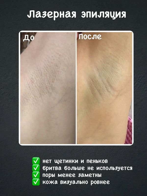Лазерная эпиляция комплекс МИНИ