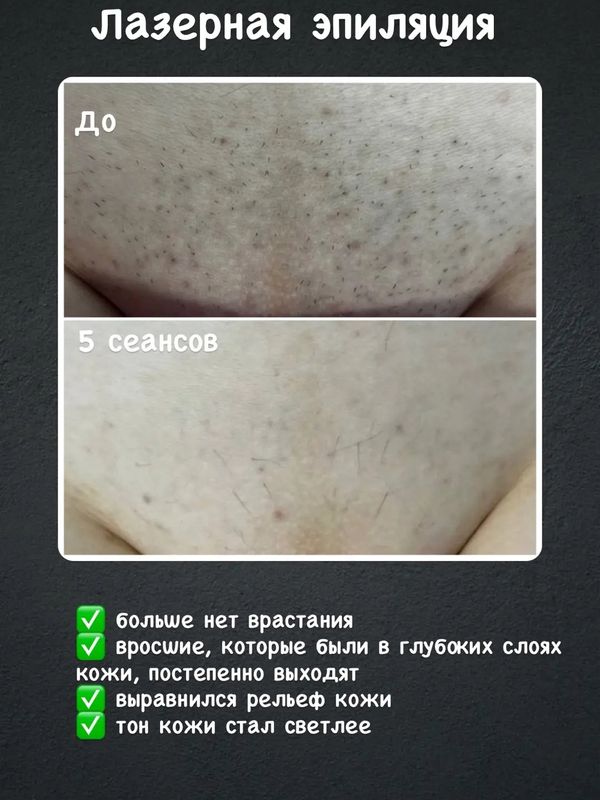 Лазерная эпиляция бикини