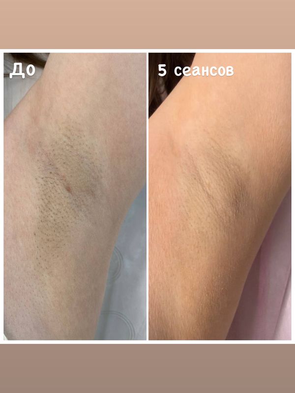Лазерная эпиляция комплекс СТАНДАРТ