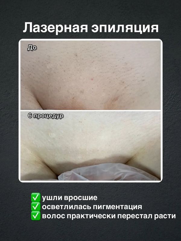 Лазерная эпиляция комплекс МИНИ