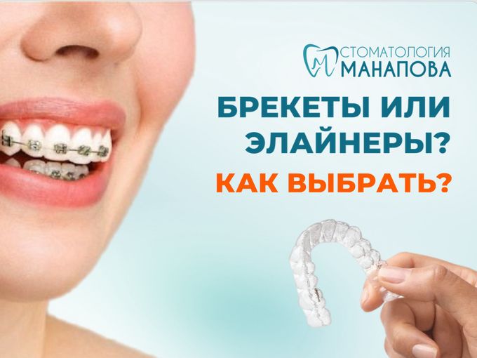 Брекеты или элайнеры? Как выбрать?